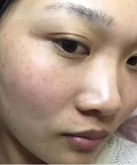 激光祛斑的效果反馈,早知道效果这么好就不犹豫那么久了