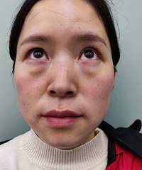 想做孩子的漂亮妈妈,年前直接安排了一台内切眼袋