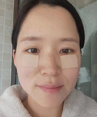 内切眼袋的注意事项(亲身体验 保姆级分享)