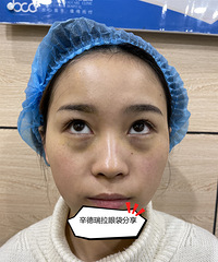 终于和遗传性眼袋术说拜拜! 效果不要太赞!