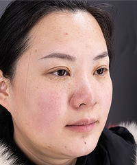 ���������Ƥ����ߣ�ֱ����Ƥ�ߺ�ȸ�����ƺͻָ�����