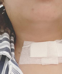记录甲状腺癌的确诊到治愈