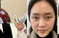 第一次医美抗衰,做完脸收紧,法令纹也变淡