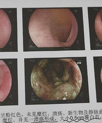 同学的父亲三个月就被确诊为贲门癌