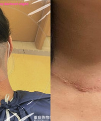 记录甲状腺癌手术后恢复记录
