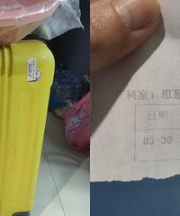 全程记录重庆市中医院痔疮手术