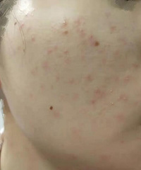 皮肤泛红长痘的姐妹,听我的!理肤泉b5面霜yyds!