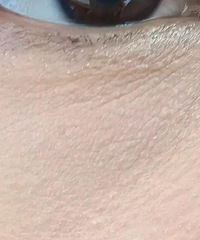 不知道咋回事,最近突然发现眼下细纹加重了!救救孩子吧