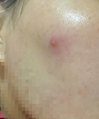 拔草oliveyoung痘痘贴!不能吸收掉痘痘,还把我的痘痘