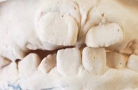 8岁儿子的箍牙记,一年了效果显著