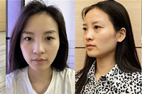 十几分钟就让超显老的“凹陷脸”饱满了
