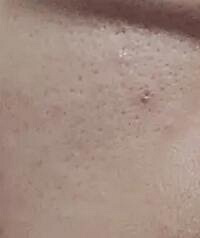 姐妹们脸颊的黑头挤不出来怎么办??