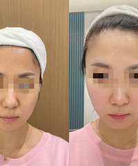 35+���Ͻ�㣬fotona4d���ڰ�������