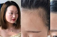 用这个方法能够拯救发际线,还立马有头发
