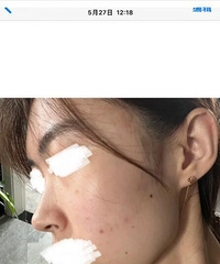 倩碧镭射你真的有点东西!分享我从5月份到现在的痘印变化