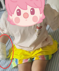 外婆在厨房煮饭,孩子被烫到了四肢,二度烧伤