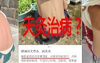 最近流行“天灸”,带孩子在太阳下暴晒,能治病?