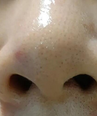 看了坛子里的去黑头帖子,我也跟着尝试了!真的好有用啊