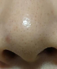 看了坛子里的去黑头帖子,我也跟着尝试了!真的好有用啊