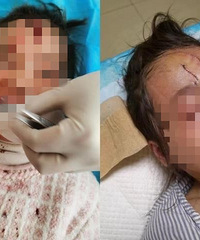 江苏一五岁女孩被狗咬伤致毁容,狗主人系公职人员