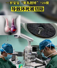 一岁宝宝“睾丸扭转”720度,导致睾丸坏死被切除