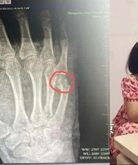 爸爸辅导作业怒吼,一拳把自己打骨折