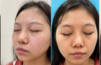 婚礼前做了热拉提,化妆师都夸我状态好