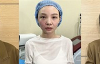 能吊打热玛吉的医美黑马,把我法令纹都祛掉了