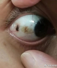 小伙相亲意外发现眼内肿瘤,成功手术