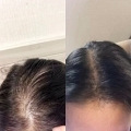 终于抗秃胜利发缝变密