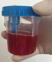 8岁的孙女上厕所尿是红色的,她支支吾吾说不清
