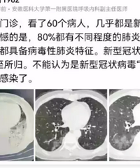 年轻人阳康后出现大白肺是怎么回事