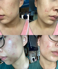 ���ܸ�Ƥ��������ʧ�������������ԣ�