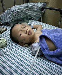 教训惨痛!这春节邻居扔偏炮仗致男童右臂受伤截肢