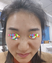 记录我打了除皱针之后的变化和前三天的真实感受