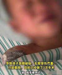 一个七岁的孩子,胳膊被爆竹完全炸断
