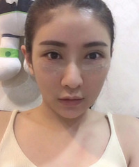 祛掉眼袋不仅看起来年轻了很多,状态都不一样了