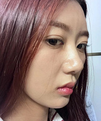 刚做完法令纹填充就后悔了,谁懂?