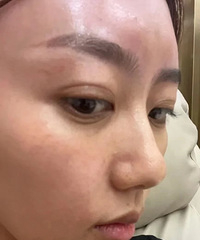 刚做完法令纹填充就后悔了,谁懂?
