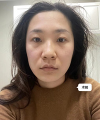 做超声炮还真不是即刻效果最好!慢慢等了半个月,法令纹才淡了
