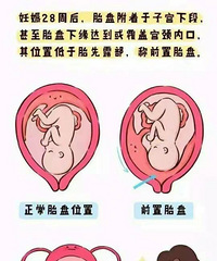 试管受孕30周,孕妈遇到可怕的产科并发症
