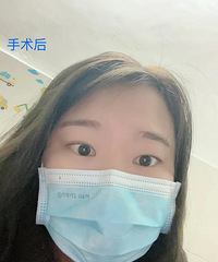 记录年前摘镜成功!普瑞眼科ICL手术分享,术后视力1.2