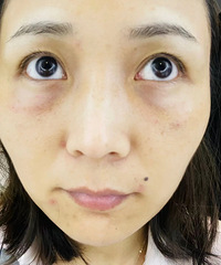 每天素面朝天的我,没想到一下子就去填了泪沟