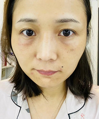每天素面朝天的我,没想到一下子就去填了泪沟