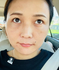 没想到这么轻松就去掉了泪沟,恢复期也一点不尴尬