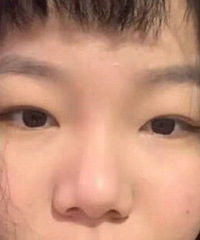 割双眼皮是一种怎样的体验,给大家分享我的经历