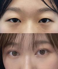 想做双眼皮的姐妹听我一句,能劝一个是一个!直接颜值翻倍