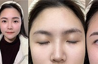 改善高低眉之后,整个五官都变精致了