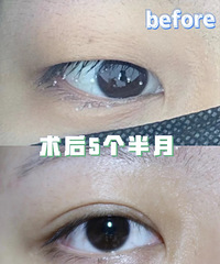 双眼皮术后5个多月就变得这么自然了,我自己也很意外