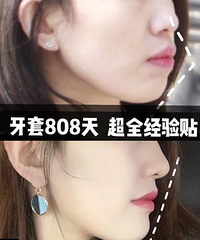 牙齿矫正2年多,颜值真的有提高,你想知道的功课都在这!